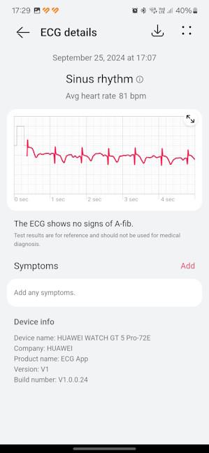 An ECG reading made on the HUAWEI WATCH GT 5 Pro